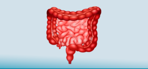 Endometriose intestinal: sintomas e tratamentos