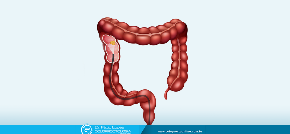 Câncer colorretal – Verdades sobre a doença que você precisa conhecer