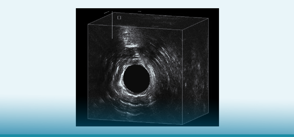Ultrassonografia Endoanal: o que é e para que serve