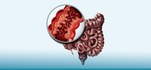 Causas e riscos da obstrução intestinal