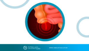 Além da apendicite: entenda os tumores originados no apêndice e seus tratamentos