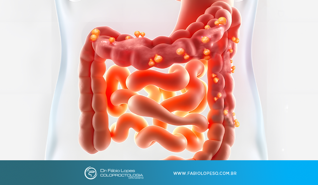 Diverticulite: Fique atento aos sinais!