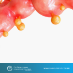 Doença diverticular: quando aqueles pequenos bolsões no intestino se tornam um problema