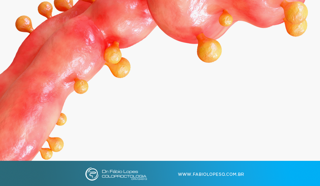 Doença diverticular: quando aqueles pequenos bolsões no intestino se tornam um problema
