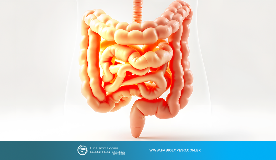 Síndrome do Intestino Irritável: o que fazer para aliviar os sintomas?