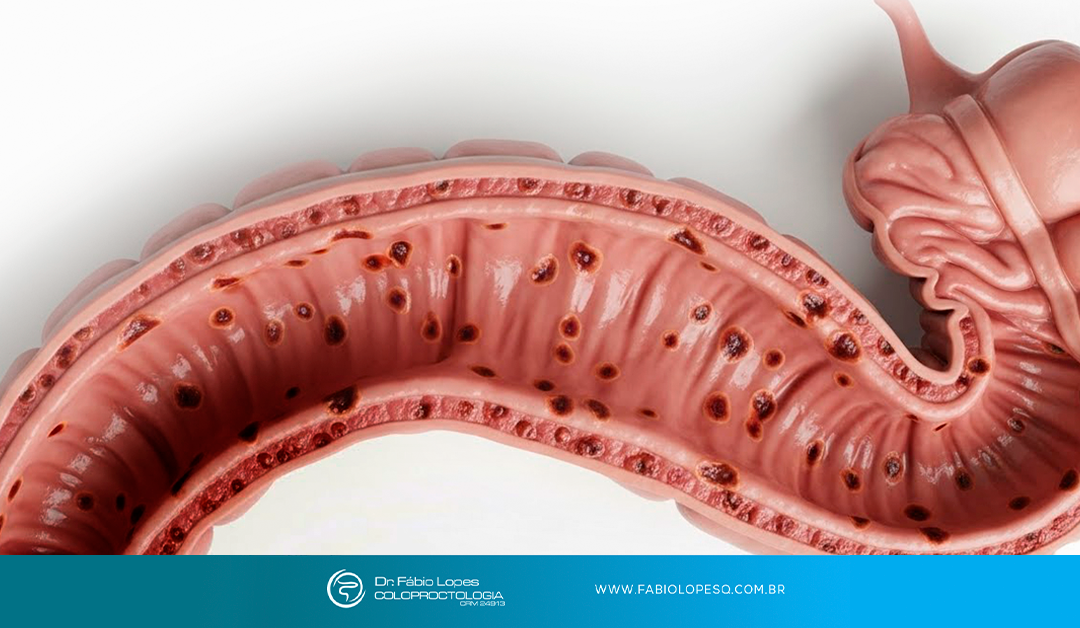 Retocolite ulcerativa e doença de Crohn: duas doenças, muitas possibilidades de controle